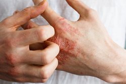 علائم پوستی ارتباطی با شدت بیماری کرونا ندارد