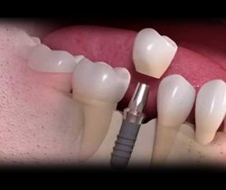 چگونه ایمپلنت و دندان های مصنوعی را تمیز نگه داریم؟
