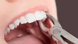 دلایلی که می گویند باید دندانتان را بکشید