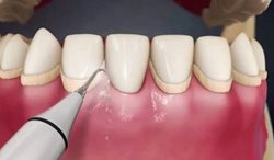 جرم گیری دندان چند بار در سال باید انجام شود؟