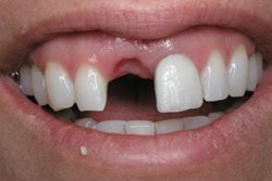 مشکلات جای خالی دندان و فاصله ایجاد شده بین دندان ها