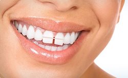 بستن فاصله میان دندان ها؛ بهترین روش کدام است؟