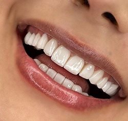 مزایا و معایب انواع روکش دندان