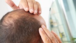 راهکار طب سنتی برای درمان ریزش مو