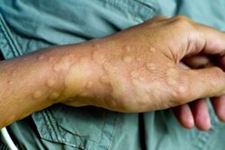 با مشکلات پوستی پس از دریافت واکسن کووید-19 چه کنیم؟