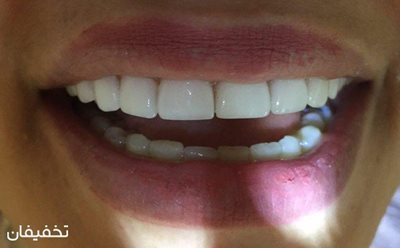 تهران-58-تخفیف-کامپوزیت-ونیر-دندان-طراحی-لبخند-هالیوودی-با-بهترین-کیفیت-کلینیک-دندانپزشکی-جام-جم-56111