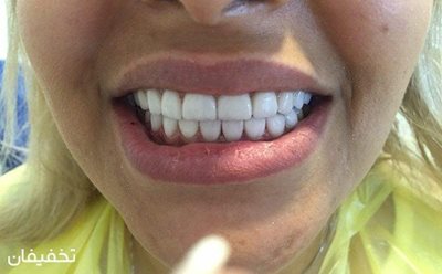 تهران-58-تخفیف-کامپوزیت-ونیر-دندان-طراحی-لبخند-هالیوودی-با-بهترین-کیفیت-کلینیک-دندانپزشکی-جام-جم-56117