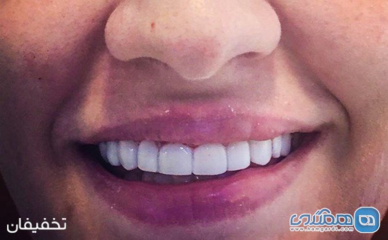 58% تخفیف کامپوزیت ونیر دندان ( طراحی لبخند هالیوودی ) با بهترین کیفیت: کلینیک دندانپزشکی جام جم