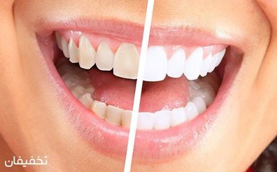 تهران-80-تخفیف-بلیچینگ-و-سفید-کردن-دندان-در-مطب-دندانپزشکی-دکتر-مرادی-57107