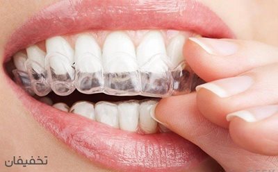تهران-80-تخفیف-بلیچینگ-و-سفید-کردن-دندان-در-مطب-دندانپزشکی-دکتر-مرادی-57108