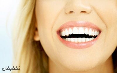تهران-80-تخفیف-بلیچینگ-و-سفید-کردن-دندان-در-مطب-دندانپزشکی-دکتر-مرادی-57104