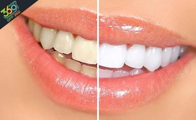 تهران-دندانهایی-سفید-و-زیبا-با-بلیچینگ-دندان-در-کلینیک-دندانپزشکی-دکتر-طایی-با-84-تخفیف-61291
