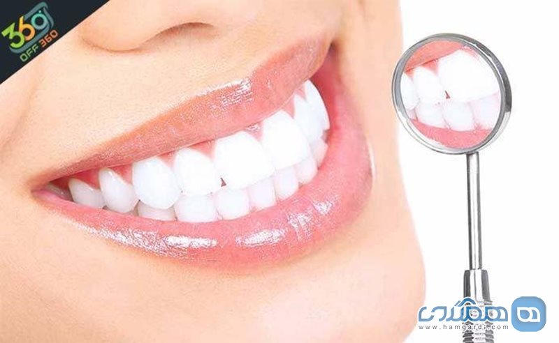دندانهایی سفید و زیبا با بلیچینگ دندان در کلینیک دندانپزشکی دکتر طایی با 84% تخفیف