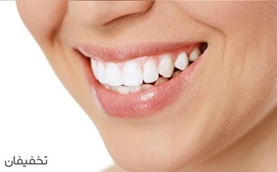 81% تخفیف بلیچینگ دندان در مطب دندانپزشکی دکتر علیزاده