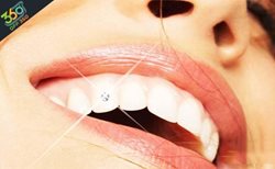 زیبایی و جذابیت بیشتر با کاشت نگین دندان در کلینیک دندانپزشکی لبخنذد زیبا