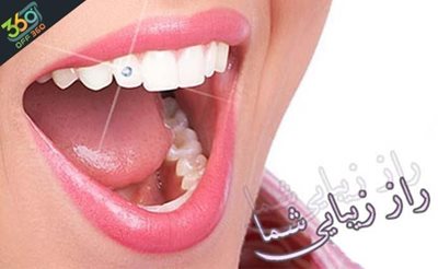 تهران-دندان-هایی-سفید-و-زیبا-با-جرم-گیری-و-بروساژ-در-کلینیک-دندانپزشکی-لبخند-زیبا-83226