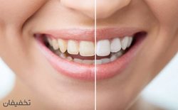 83% تخفیف لبخندی زیبا در مطب دندانپزشکی دکتر سینا سلوتی سرخه