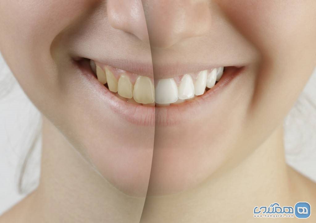 سفید کردن دندان 3