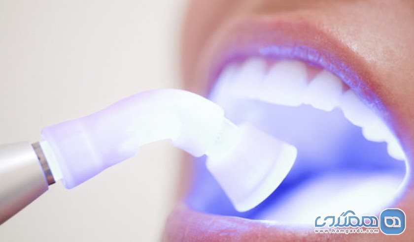 سفید کردن دندان 5