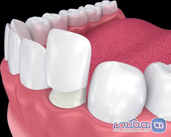 روش روکش دندان