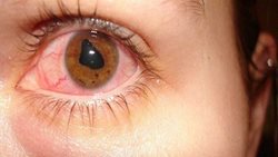 مالیدن چشم ها باعث این بیماری می شود