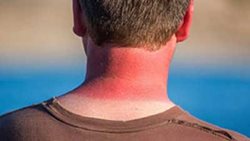 آفتاب سوختگی بیش از حد چه بلایی سرتان می آورد؟