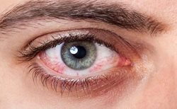 قرمزی چشم ها چه زمانی خطرناک است؟