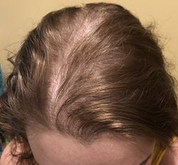 چرا خانم ها دچار ریزش مو می شوند؟