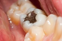 پر کردن دندان با آمالگام برای کدام افراد خطرناک است؟