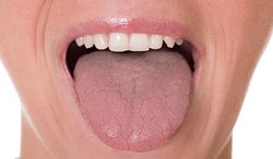 چگونه چسبندگی بزاق دهان را درمان کنیم؟
