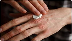 6 راهکار ساده برای درمان اگزمای پوستی