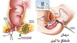 درمان شقاق با بهترین روش (لیزر)