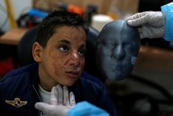 ماسک سه بعدی برای قربانیان سوختگی صورت + عکس