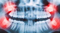 مشکلات رایج دندان عقل و راه حل