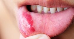 زخم های ماندگار دهان نشان دهنده چیست؟