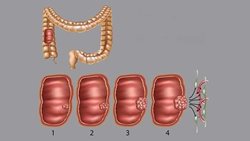 آشنایی با 4 مرحله سرطان روده