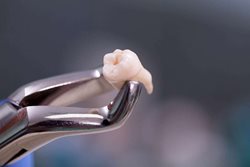 راههای مراقبت از دهان بعد از کشیدن دندان