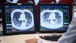 درمانی برای فیبروز ریه بهبودیافتگان کرونایی وجود دارد؟