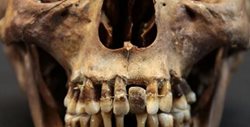 تن دادن یک زن اشرافی قرن هفدهمی به عمل دردناک دندانپزشکی برای حفظ دندانهای خود