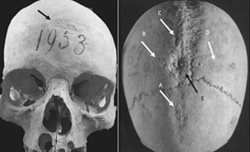 نشانه هایی از انجام دو عمل جراحی روی جمجمه یک زن قرون وسطایی