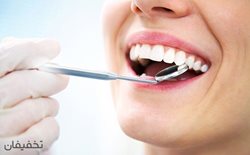 90% تخفیف یک جلسه جرم گیری دندان در دندانپزشکی لبخند