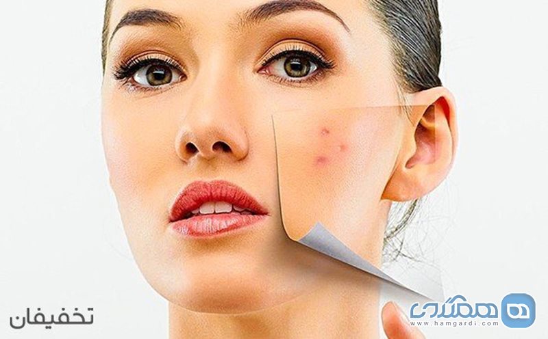 85% تخفیف آکنه تراپی و درمان کامل جوش در مطب دکتر امینی