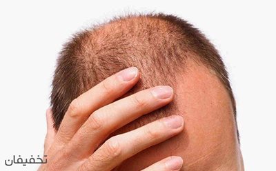 90% تخفیف  درمان ریزش مو با دستگاه فرکشنال در مطب دکتر شیرالی