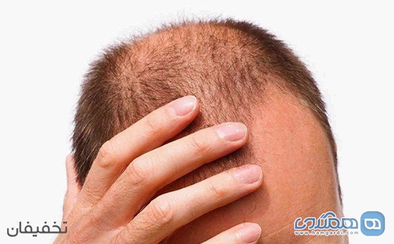90% تخفیف  درمان ریزش مو با دستگاه فرکشنال در مطب دکتر شیرالی