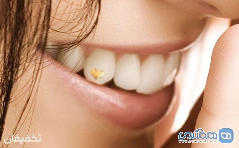 92% تخفیف کاشت نگین دندان در مطب دندان پزشکی دکتر علیزاده به همراه نگین ساده رایگان