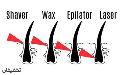 تهران-96-تخفیف-لیزرموهای-زائد-الکساندرایت-2016-در-بهتین-59706