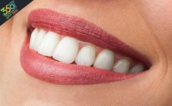 دندانهایی سفید و زیبا با بلیچینگ دندان در کلینیک دندانپزشکی دکتر طایی با 84% تخفیف