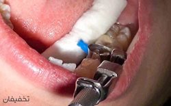 80% تخفیف دندانپزشکی زیبایی دکتر اکتایی