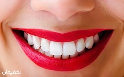 تهران-66-تخفیف-خدمات-متنوع-زیبایی-دندان-در-دندانپزشکی-لبخند-سفید-71047