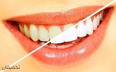 90% تخفیف انواع خدمات دندانپزشکی در کلینیک دندانپزشکی هامون